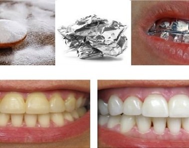 Qué pasa cuando envuelves tus dientes en papel aluminio