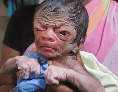 Nace bebé con rostro de un señor de 80 años y un cuerpo lleno de pelos