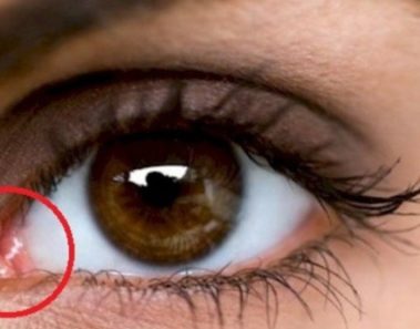¿Tienes esto en la esquina de tus ojos?