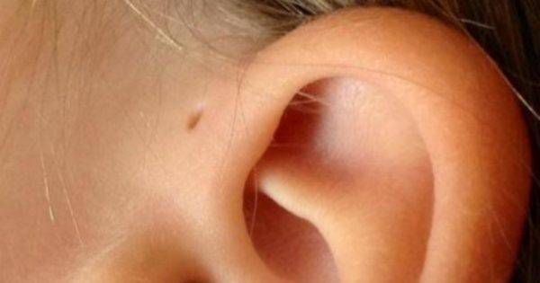 Solo 1 de cada 100 personas nace con este orificio en alguna de sus orejas. ¿Sabes qué es?