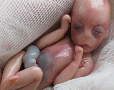 A los 5 meses nació muerta, pero lograron revivirla. Nadie puede creer cómo luce hoy