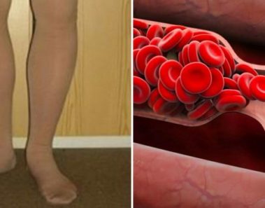 consejos para prevenir trombosis