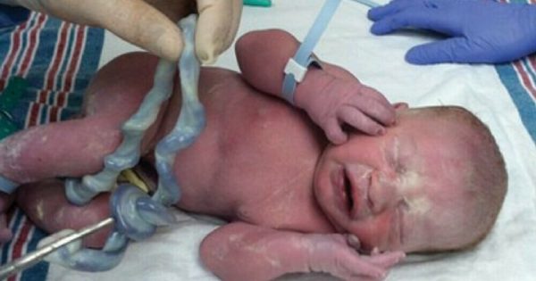 Médicos creen que el bebé nació sano, miran el cordón umbilical otra vez y entienden lo increíble