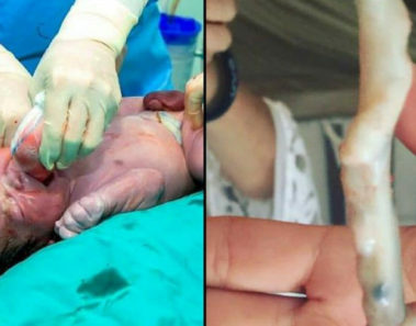 Médicos creen que el bebé nació sano, miran el cordón umbilical otra vez y entienden lo increíble