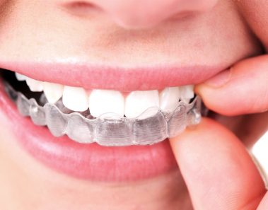 invisalign ortodoncia invisible