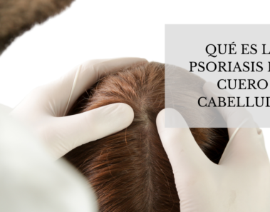 Qué es la psoriasis del cuero cabelludo